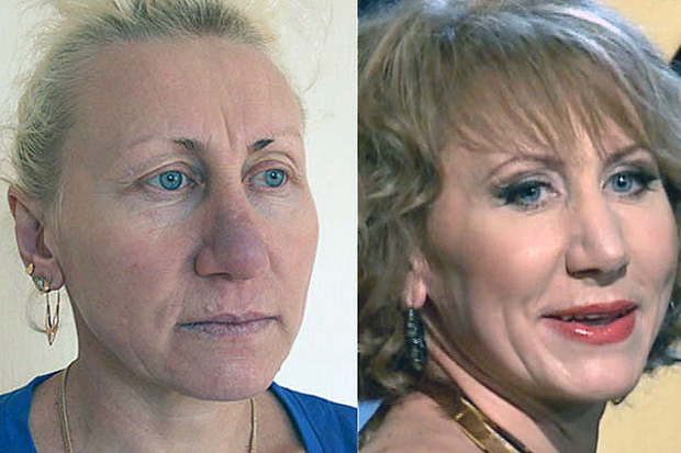 Елена яковлева пластика лица фото до и после